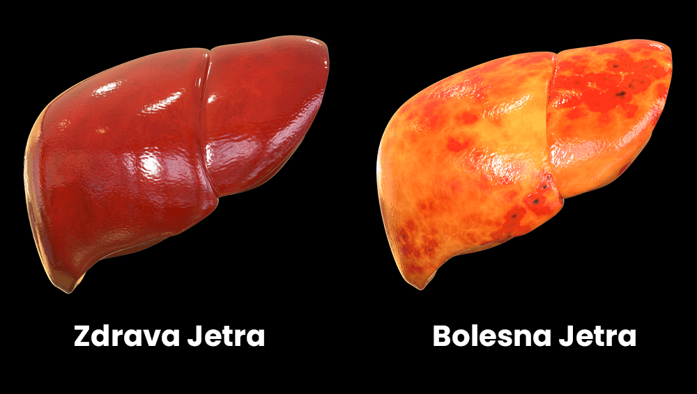 Bolesti jetre od alkohola Slika bolesne i zdrave jetre razlika